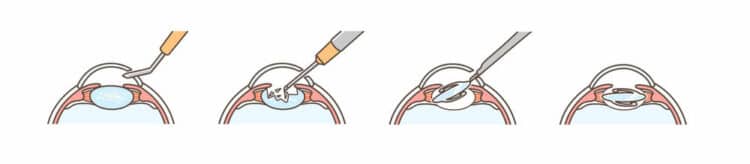 Cataract Surgery Port Orange | Cataracts Ormond Beach, FL